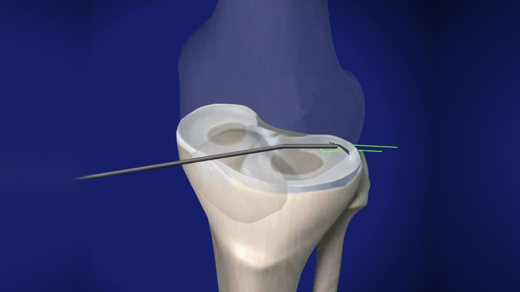 The Long-Term Effects of Meniscus Repair: Does it Increase ...