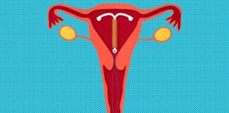 The Pros and Cons of Intrauterine Devices