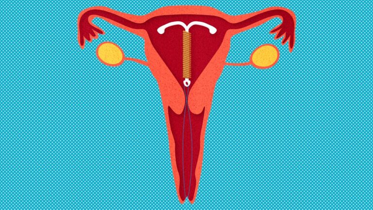 The Pros and Cons of Intrauterine Devices: Is an IUD Right for You ...